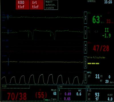 Advanced Atrio-Ventricular Blocks in a Foal Undergoing Surgical Bladder Repair: First Step to Cardiac Arrest?